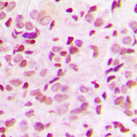 IHC-P analysis of formalin fixed human breast cancer tissue section using GTX54983 NFkB p65 (phospho Thr435) antibody. Antigen retrieval : Heat mediated antigen retrieval with sodium citrate buffer (pH 6.0)