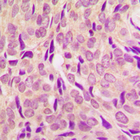 IHC-P analysis of formalin fixed human breast cancer tissue section using GTX54985 RPS6 (phospho Ser240) antibody. Antigen retrieval : Heat mediated antigen retrieval with sodium citrate buffer (pH 6.0)