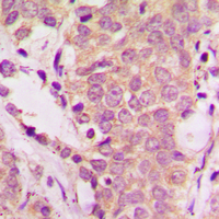 IHC-P analysis of formalin fixed human prostate cancer tissue section using GTX54986 SHC1 (phospho Tyr239) antibody. Antigen retrieval : Heat mediated antigen retrieval with sodium citrate buffer (pH 6.0) IHC-P analysis of formalin fixed human prostate cancer tissue section using GTX54986 SHC1 (phospho Tyr239) antibody. Antigen retrieval : Heat mediated antigen retrieval with sodium citrate buffer (pH 6.0)