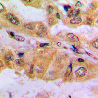 IHC-P analysis of formalin fixed human lung cancer tissue section using GTX54987 SMAD2 (phospho Ser467) antibody. Antigen retrieval : Heat mediated antigen retrieval with sodium citrate buffer (pH 6.0)