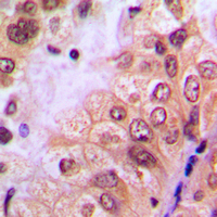 IHC-P analysis of formalin fixed human breast cancer tissue section using GTX54998 c-Abl (phospho Tyr204) antibody. Antigen retrieval : Heat mediated antigen retrieval with sodium citrate buffer (pH 6.0) IHC-P analysis of formalin fixed human breast cancer tissue section using GTX54998 c-Abl (phospho Tyr204) antibody. Antigen retrieval : Heat mediated antigen retrieval with sodium citrate buffer (pH 6.0)