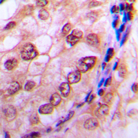 IHC-P analysis of formalin fixed human breast cancer tissue section using GTX55007 CDC6 (phospho Ser54) antibody. Antigen retrieval : Heat mediated antigen retrieval with sodium citrate buffer (pH 6.0) IHC-P analysis of formalin fixed human breast cancer tissue section using GTX55007 CDC6 (phospho Ser54) antibody. Antigen retrieval : Heat mediated antigen retrieval with sodium citrate buffer (pH 6.0)