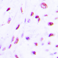 IHC-P analysis of formalin fixed human lung cancer tissue section using GTX55008 C/EBP beta (phospho Thr235) antibody. Antigen retrieval : Heat mediated antigen retrieval with sodium citrate buffer (pH 6.0)