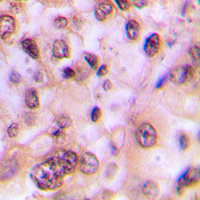 IHC-P analysis of formalin fixed human breast cancer tissue section using GTX55012 GSK3 beta (phospho Ser9) antibody. Antigen retrieval : Heat mediated antigen retrieval with sodium citrate buffer (pH 6.0) IHC-P analysis of formalin fixed human breast cancer tissue section using GTX55012 GSK3 beta (phospho Ser9) antibody. Antigen retrieval : Heat mediated antigen retrieval with sodium citrate buffer (pH 6.0)