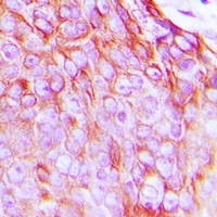 IHC-P analysis of formalin fixed human breast cancer tissue section using GTX55015 Insulin Receptor beta (phospho Tyr1322) antibody. Antigen retrieval : Heat mediated antigen retrieval with sodium citrate buffer (pH 6.0)