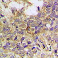 IHC-P analysis of formalin fixed human breast cancer tissue section using GTX55026 Paxillin (phospho Tyr31) antibody. Antigen retrieval : Heat mediated antigen retrieval with sodium citrate buffer (pH 6.0) IHC-P analysis of formalin fixed human breast cancer tissue section using GTX55026 Paxillin (phospho Tyr31) antibody. Antigen retrieval : Heat mediated antigen retrieval with sodium citrate buffer (pH 6.0)