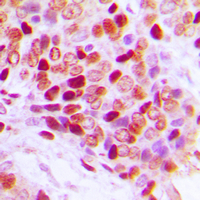 IHC-P analysis of formalin fixed human breast cancer tissue section using GTX55031 Splicing factor 1 (phospho Ser82) antibody. Antigen retrieval : Heat mediated antigen retrieval with sodium citrate buffer (pH 6.0)