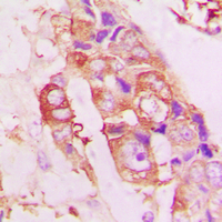 IHC-P analysis of formalin fixed human lung cancer tissue section using GTX55035 Stathmin 1 (phospho Ser25) antibody. Antigen retrieval : Heat mediated antigen retrieval with sodium citrate buffer (pH 6.0)