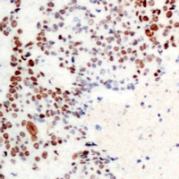 IHC-P analysis of formalin fixed human prostate cancer tissue section using GTX55046 ATF2 (phospho Thr71) antibody. Antigen retrieval : Heat mediated antigen retrieval with sodium citrate buffer (pH 6.0) IHC-P analysis of formalin fixed human prostate cancer tissue section using GTX55046 ATF2 (phospho Thr71) antibody. Antigen retrieval : Heat mediated antigen retrieval with sodium citrate buffer (pH 6.0)