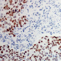 IHC-P analysis of formalin fixed human prostate cancer tissue section using GTX55047 ATF2 (phospho Thr73) antibody. Antigen retrieval : Heat mediated antigen retrieval with sodium citrate buffer (pH 6.0) IHC-P analysis of formalin fixed human prostate cancer tissue section using GTX55047 ATF2 (phospho Thr73) antibody. Antigen retrieval : Heat mediated antigen retrieval with sodium citrate buffer (pH 6.0)