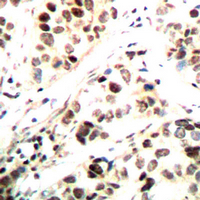 IHC-P analysis of formalin fixed human breast cancer tissue section using GTX55053 Chk1 (phospho Ser296) antibody. Antigen retrieval : Heat mediated antigen retrieval with sodium citrate buffer (pH 6.0) IHC-P analysis of formalin fixed human breast cancer tissue section using GTX55053 Chk1 (phospho Ser296) antibody. Antigen retrieval : Heat mediated antigen retrieval with sodium citrate buffer (pH 6.0)