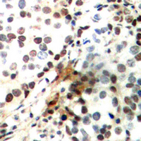 IHC-P analysis of formalin fixed human breast cancer tissue section using GTX55056 CREB (phospho Ser142) antibody. Antigen retrieval : Heat mediated antigen retrieval with sodium citrate buffer (pH 6.0)
