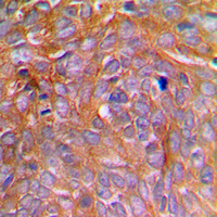 IHC-P analysis of formalin fixed human breast cancer tissue section using GTX55080 Caspase 8 (phospho Ser347) antibody. Antigen retrieval : Heat mediated antigen retrieval with sodium citrate buffer (pH 6.0) IHC-P analysis of formalin fixed human breast cancer tissue section using GTX55080 Caspase 8 (phospho Ser347) antibody. Antigen retrieval : Heat mediated antigen retrieval with sodium citrate buffer (pH 6.0)