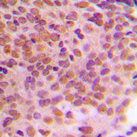 IHC-P analysis of formalin fixed human breast cancer tissue section using GTX55085 Cyclin B1 (phospho Ser126) antibody. Antigen retrieval : Heat mediated antigen retrieval with sodium citrate buffer (pH 6.0)