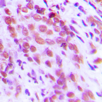 IHC-P analysis of formalin fixed human breast cancer tissue section using GTX55113 NFkB p65 (phospho Ser276) antibody. Antigen retrieval : Heat mediated antigen retrieval with sodium citrate buffer (pH 6.0) IHC-P analysis of formalin fixed human breast cancer tissue section using GTX55113 NFkB p65 (phospho Ser276) antibody. Antigen retrieval : Heat mediated antigen retrieval with sodium citrate buffer (pH 6.0)