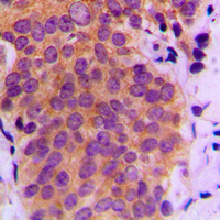 IHC-P analysis of formalin fixed human breast cancer tissue section using GTX55115 SEK1 / MKK4 (phospho Ser80) antibody. Antigen retrieval : Heat mediated antigen retrieval with sodium citrate buffer (pH 6.0)