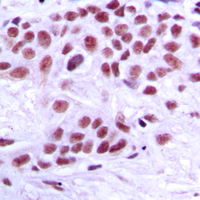 IHC-P analysis of formalin fixed human breast cancer tissue section using GTX55164 MED1 antibody. Antigen retrieval : Heat mediated antigen retrieval with sodium citrate buffer (pH 6.0)