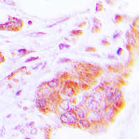 IHC-P analysis of formalin fixed human lung cancer tissue section using GTX55188 COX17 antibody. Antigen retrieval : Heat mediated antigen retrieval with sodium citrate buffer (pH 6.0)