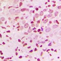 IHC-P analysis of formalin fixed human breast cancer tissue section using GTX55226 ZNF174 antibody. Antigen retrieval : Heat mediated antigen retrieval with sodium citrate buffer (pH 6.0)