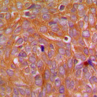 IHC-P analysis of formalin fixed human breast cancer tissue section using GTX55231 CARD14 antibody. Antigen retrieval : Heat mediated antigen retrieval with sodium citrate buffer (pH 6.0)
