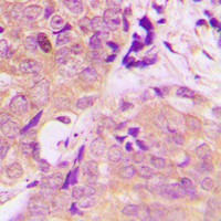 IHC-P analysis of formalin fixed human prostate cancer tissue section using GTX55280 CARKL antibody. Antigen retrieval : Heat mediated antigen retrieval with sodium citrate buffer (pH 6.0) IHC-P analysis of formalin fixed human prostate cancer tissue section using GTX55280 CARKL antibody. Antigen retrieval : Heat mediated antigen retrieval with sodium citrate buffer (pH 6.0)
