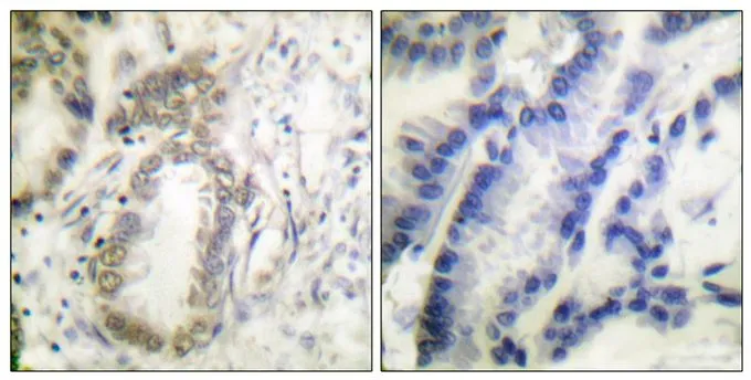 IHC-P analysis of human colon carcinoma tissue using GTX55304 C/EBP alpha (phospho Ser21) antibody. Left : Primary antibody Right : Primary antibody pre-incubated with the antigen specific peptide IHC-P analysis of human colon carcinoma tissue using GTX55304 C/EBP alpha (phospho Ser21) antibody. Left : Primary antibody Right : Primary antibody pre-incubated with the antigen specific peptide