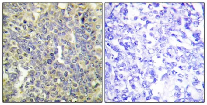 IHC-P analysis of human lung carcinoma tissue using GTX55305 Caspase 9 (phospho Thr125) antibody. Left : Primary antibody Right : Primary antibody pre-incubated with the antigen specific peptide IHC-P analysis of human lung carcinoma tissue using GTX55305 Caspase 9 (phospho Thr125) antibody. Left : Primary antibody Right : Primary antibody pre-incubated with the antigen specific peptide
