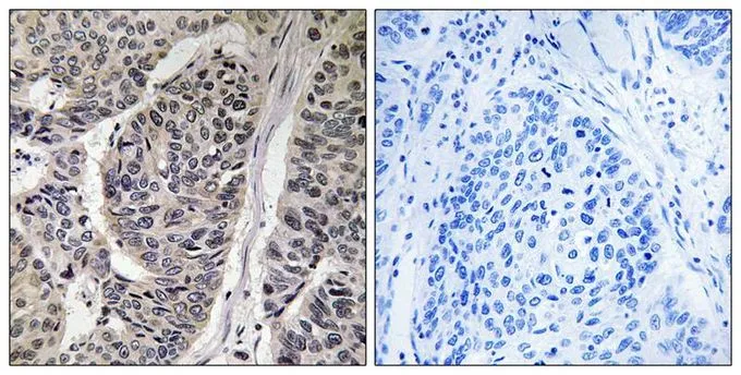 IHC-P analysis of human breast carcinoma tissue using GTX55306 p130Cas (phospho Tyr410) antibody. Left : Primary antibody Right : Primary antibody pre-incubated with the antigen specific peptide IHC-P analysis of human breast carcinoma tissue using GTX55306 p130Cas (phospho Tyr410) antibody. Left : Primary antibody Right : Primary antibody pre-incubated with the antigen specific peptide