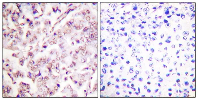 IHC-P analysis of human breast carcinoma tissue using GTX55307 ETS1 (phospho Thr38) antibody. Left : Primary antibody Right : Primary antibody pre-incubated with the antigen specific peptide