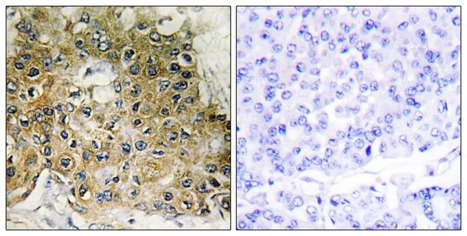 IHC-P analysis of human breast carcinoma tissue using GTX55308 Integrin beta 1 / CD29 (phospho Thr789) antibody. Left : Primary antibody Right : Primary antibody pre-incubated with the antigen specific peptide IHC-P analysis of human breast carcinoma tissue using GTX55308 Integrin beta 1 / CD29 (phospho Thr789) antibody. Left : Primary antibody Right : Primary antibody pre-incubated with the antigen specific peptide