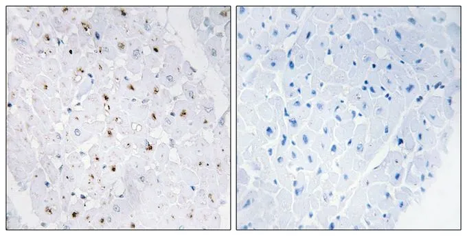 IHC-P analysis of human heart tissue using GTX55314 BLM (phospho Thr99) antibody. Left : Primary antibody Right : Primary antibody pre-incubated with the antigen specific peptide IHC-P analysis of human heart tissue using GTX55314 BLM (phospho Thr99) antibody. Left : Primary antibody Right : Primary antibody pre-incubated with the antigen specific peptide