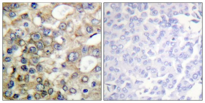 IHC-P analysis of human breast carcinoma tissue using GTX55325 MUC1 (phospho Tyr1229) antibody. Left : Primary antibody Right : Primary antibody pre-incubated with the antigen specific peptide