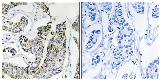 IHC-P analysis of human breast carcinoma tissue using GTX55328 BLK (phospho Tyr501) antibody. Left : Primary antibody Right : Primary antibody pre-incubated with the antigen specific peptide IHC-P analysis of human breast carcinoma tissue using GTX55328 BLK (phospho Tyr501) antibody. Left : Primary antibody Right : Primary antibody pre-incubated with the antigen specific peptide