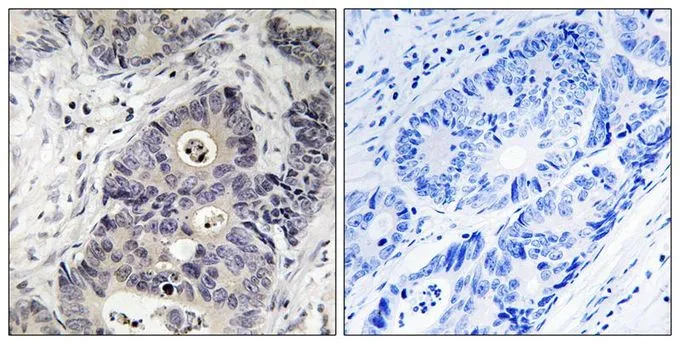 IHC-P analysis of human colon carcinoma tissue using GTX55338 iNOS (phospho Tyr151) antibody. Left : Primary antibody Right : Primary antibody pre-incubated with the antigen specific peptide IHC-P analysis of human colon carcinoma tissue using GTX55338 iNOS (phospho Tyr151) antibody. Left : Primary antibody Right : Primary antibody pre-incubated with the antigen specific peptide