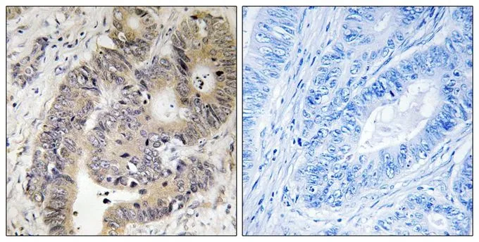 IHC-P analysis of human colon carcinoma tissue using GTX55350 CAD (phospho Thr456) antibody. Left : Primary antibody Right : Primary antibody pre-incubated with the antigen specific peptide