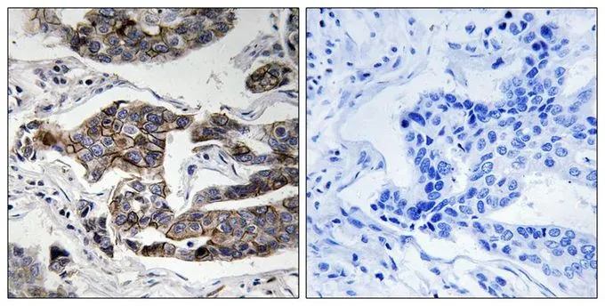 IHC-P analysis of human breast carcinoma tissue using GTX55363 Girdin (phospho Ser1417) antibody. Left : Primary antibody Right : Primary antibody pre-incubated with the antigen specific peptide IHC-P analysis of human breast carcinoma tissue using GTX55363 Girdin (phospho Ser1417) antibody. Left : Primary antibody Right : Primary antibody pre-incubated with the antigen specific peptide