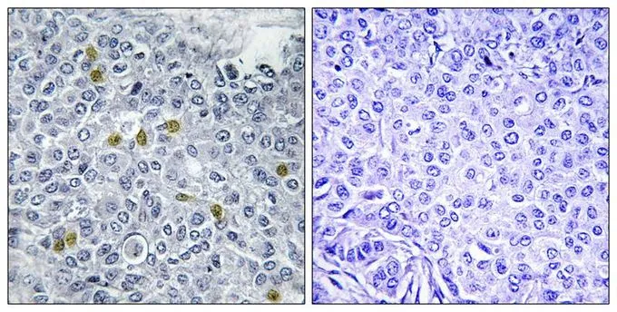 IHC-P analysis of human breast carcinoma tissue using GTX55437 Topoisomerase II alpha (phospho Ser1106) antibody. Left : Primary antibody Right : Primary antibody pre-incubated with the antigen specific peptide