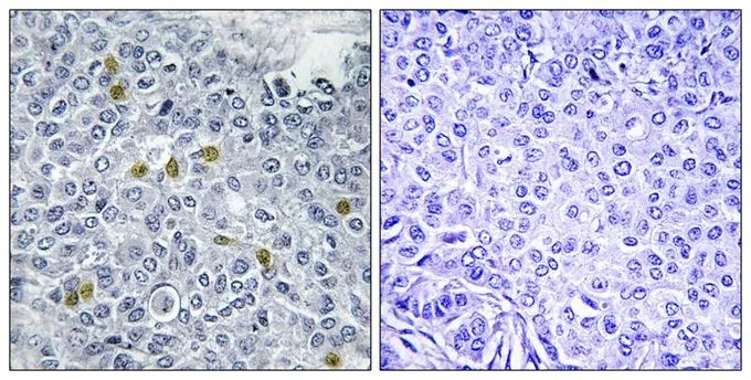 IHC-P analysis of human breast carcinoma tissue using GTX55437 Topoisomerase II alpha (phospho Ser1106) antibody. Left : Primary antibody Right : Primary antibody pre-incubated with the antigen specific peptide IHC-P analysis of human breast carcinoma tissue using GTX55437 Topoisomerase II alpha (phospho Ser1106) antibody. Left : Primary antibody Right : Primary antibody pre-incubated with the antigen specific peptide