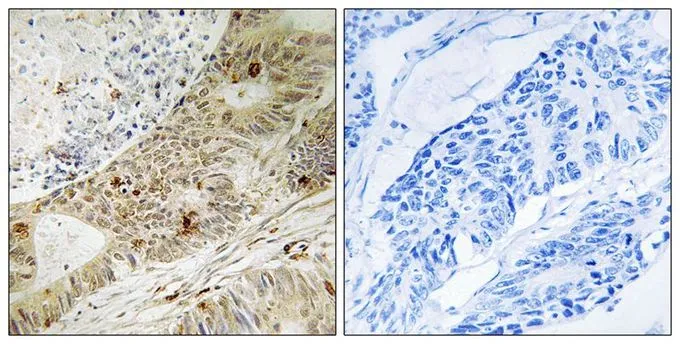 IHC-P analysis of human colon carcinoma tissue using GTX55441 ATRIP (phospho Ser224) antibody. Left : Primary antibody Right : Primary antibody pre-incubated with the antigen specific peptide IHC-P analysis of human colon carcinoma tissue using GTX55441 ATRIP (phospho Ser224) antibody. Left : Primary antibody Right : Primary antibody pre-incubated with the antigen specific peptide