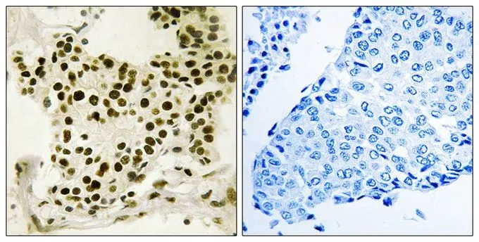 IHC-P analysis of human breast carcinoma tissue using GTX55450 UBTF (phospho Ser484) antibody. Left : Primary antibody Right : Primary antibody pre-incubated with the antigen specific peptide IHC-P analysis of human breast carcinoma tissue using GTX55450 UBTF (phospho Ser484) antibody. Left : Primary antibody Right : Primary antibody pre-incubated with the antigen specific peptide