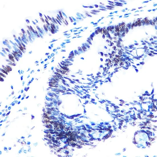 IHC-P analysis of human colon carcinoma tissue using GTX55474 SMC1 (phospho Ser957) antibody. Dilution : 1:100