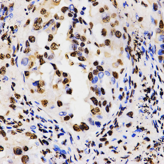 IHC-P analysis of human kidney cancer tissue using GTX55484 Histone H3R17me2 (di-methyl Arg17) antibody. Dilution : 1:200