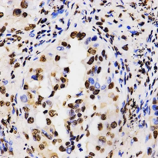 IHC-P analysis of human lung cancer tissue using GTX55484 Histone H3R17me2 (di-methyl Arg17) antibody. Dilution : 1:200