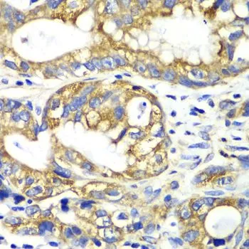 IHC-P analysis of human gastric cancer tissue using GTX55493 Adenylate kinase 2 antibody. Dilution : 1:100