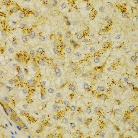 IHC-P analysis of human liver cancer tissue using GTX55505 alpha Actinin 1 antibody. Dilution : 1:100