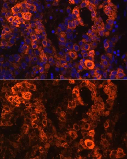 IHC-P analysis of human liver cancer tissue using GTX55537 BHMT antibody. Blue : DAPI Dilution : 1:100