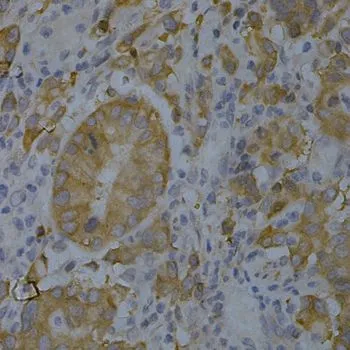 IHC-P analysis of human gastric cancer tissue using GTX55538 BIN1 antibody. Dilution : 1:200