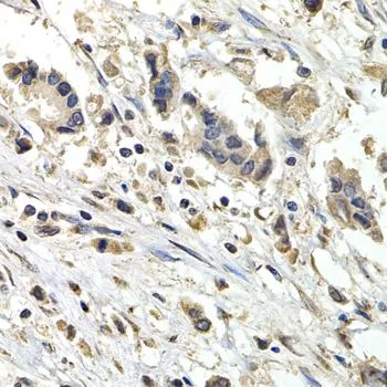 IHC-P analysis of human breast cancer tissue using GTX55541 BUB1B antibody. Dilution : 1:200