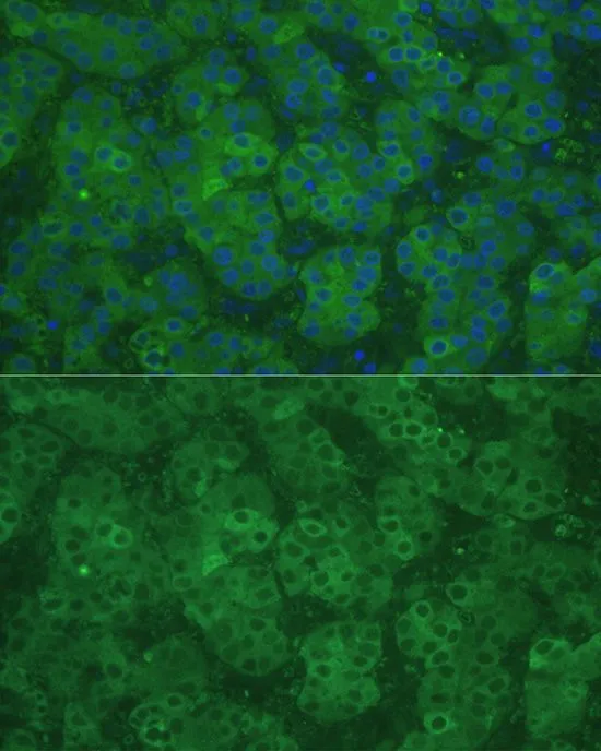 IHC-P analysis of human liver cancer tissue using GTX55551 CBS antibody. Blue : DAPI Dilution : 1:100