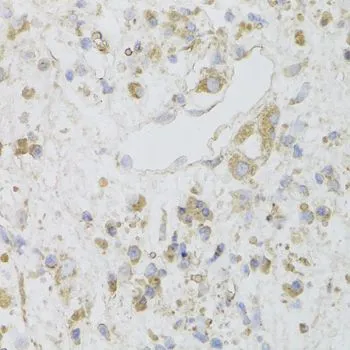IHC-P analysis of human gastric cancer tissue using GTX55572 CIAPIN1 antibody. Dilution : 1:100